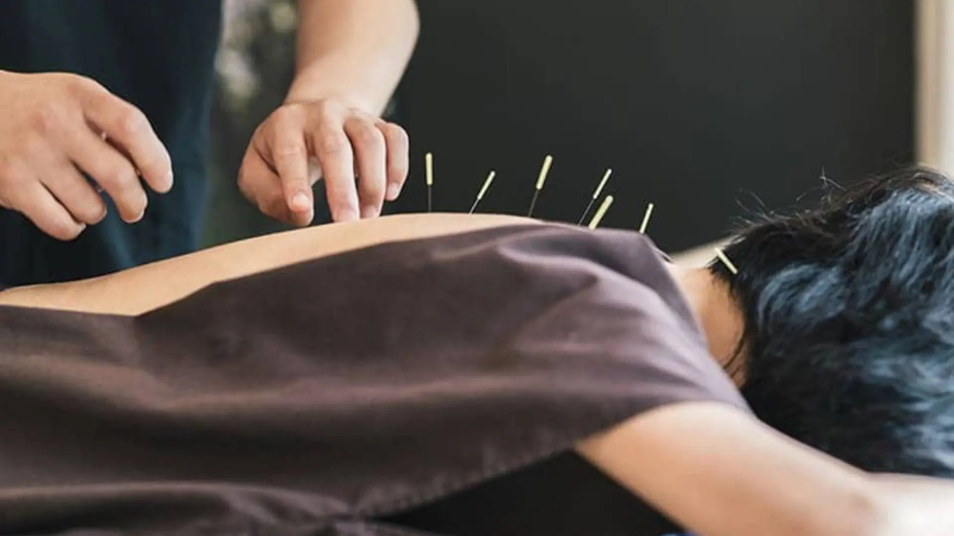 68309925e1baf_accupuncture2 Person receiving acupuncture treatment with needles inserted in their back.